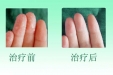 我院成功开展手汗症微创外科手术
