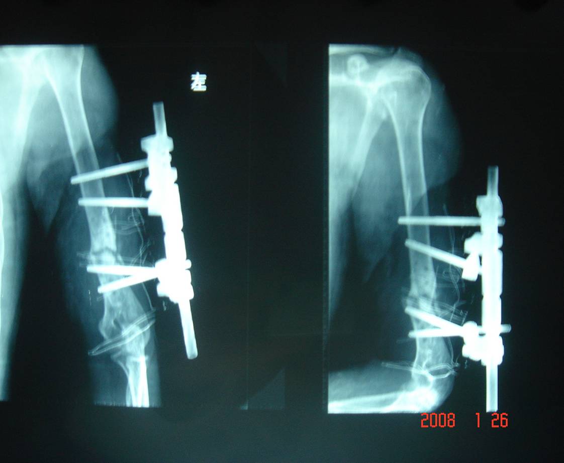 左肱骨下1/3骨折內固定術後骨不連-科室動態-骨傷科-科室導航-湖南中
