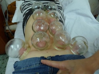 拔火罐