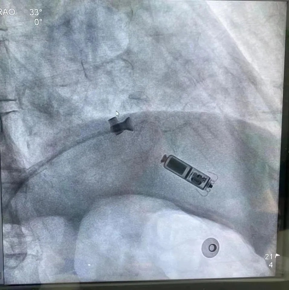 而且對傳統起搏器植入手術有顧慮,經心血管內科龍雲主任醫師帶領心臟