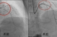 老人冠脉严重狭窄，医生用这种方式打通心脏血管“隧道”