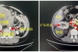 男子腹部长出3个巨大肿瘤，多学科联动顺利切除8斤重肿块