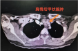 不开胸，巧“排雷”！腋下小孔，巧摘胸骨后甲状腺肿