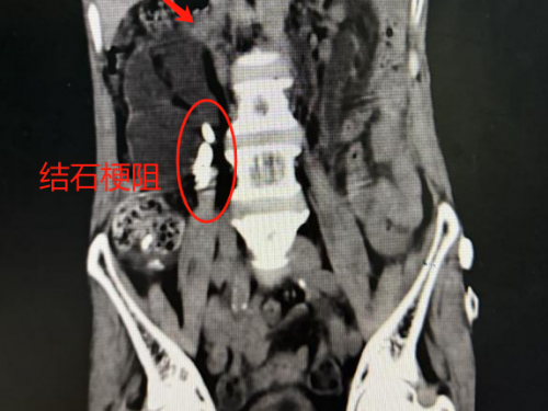 突然腰疼尿少，小心是这个病......