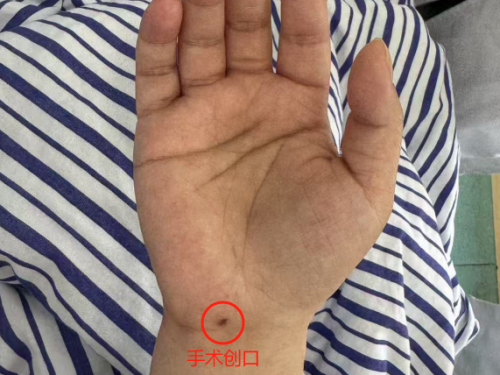 得了“鼠标手”怎么办？试试这一招