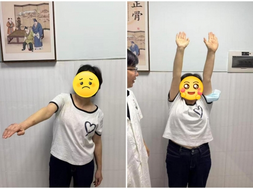 56岁阿姨遭遇“五十肩”！医生用这方法，化解1年肩僵痛
