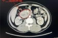 高空走钢丝，毫米级精准！医生巧手切除腹腔直径6厘米肿瘤