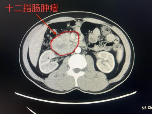 高空走钢丝，毫米级精准！医生巧手切除腹腔直径6厘米肿瘤