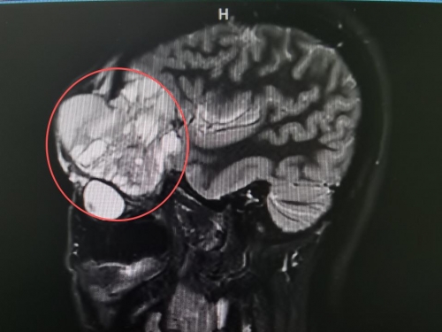 32岁女子容貌变形、左眼快瞎！我院多学科联动拆除“颅底炸弹”