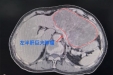 巨大肿瘤占据84岁老人半个肝脏！多学科联动顺利脱险