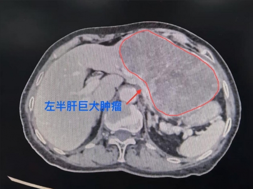 巨大肿瘤占据84岁老人半个肝脏！多学科联动顺利脱险