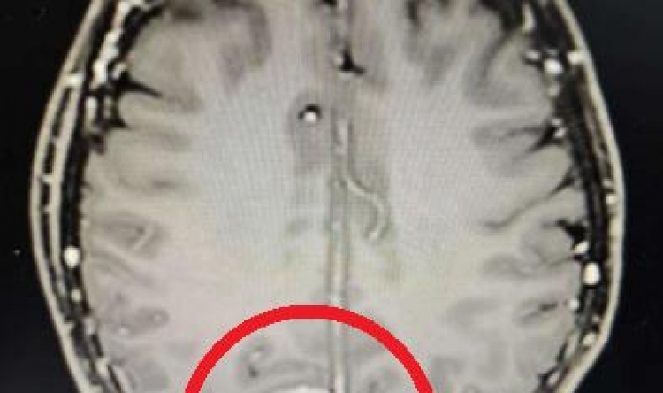 为脑手术装上“导航仪”！让肿瘤“无处遁形”